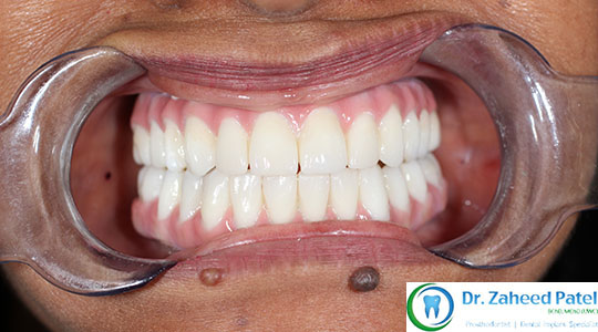 Case 2 after treatment