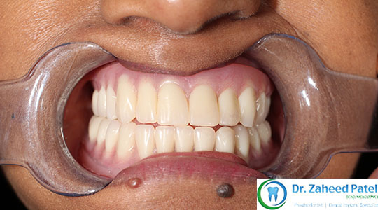 Case 2 before treatment