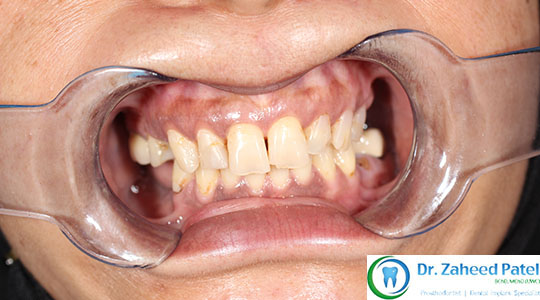 Case 3 before treatment