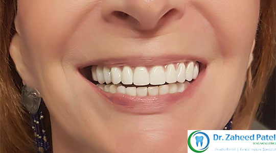 Case 4 before treatment