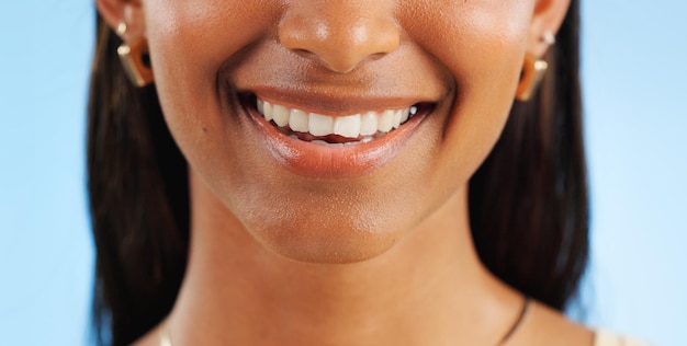 Dental Veneers