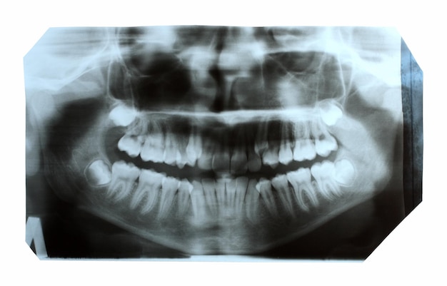 Sinus Augmentation
