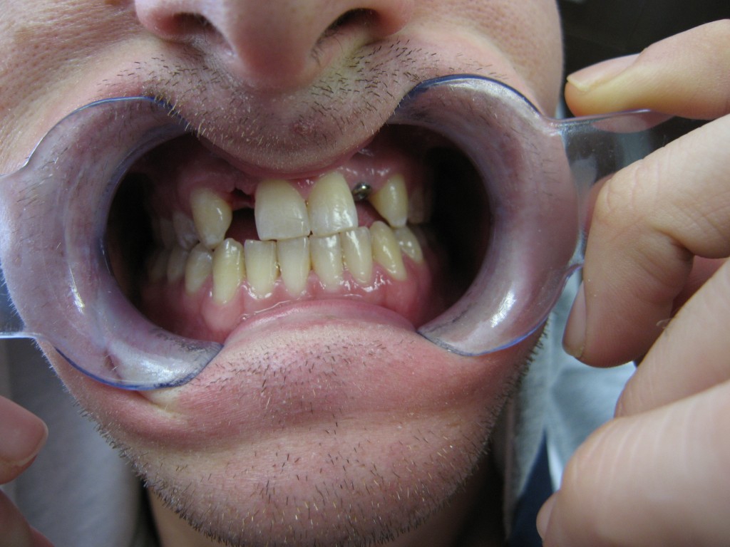 Dental Implants Dental Implants Cape Town Dental Implant Specialist Prosthodontist